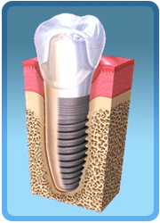 Dental Implants Palmdale California