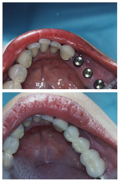 Dental Implants Palmdale CA