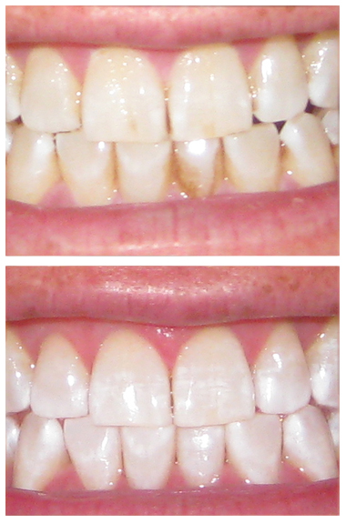Teeth Whitening Palmdale