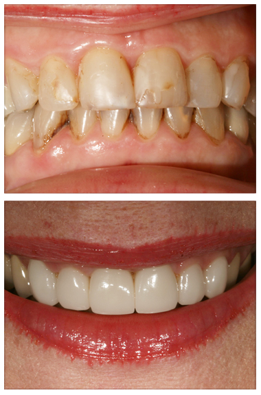 Teeth Whitening Palmdale CA