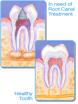 Root Canals Palmdale CA