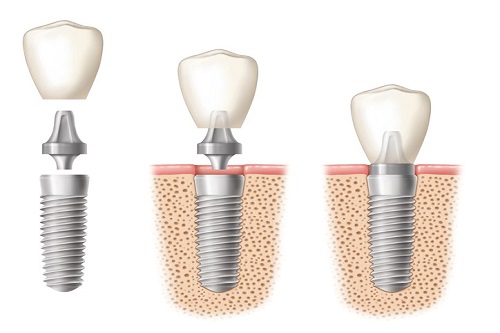 Dental Implants Lancaster CA