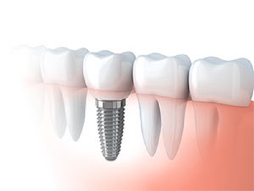 Dental Implants Lancaster