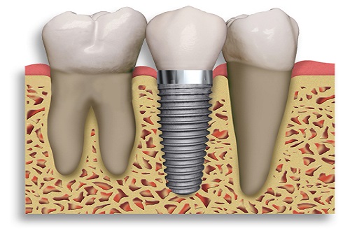 Dental Implants Lancaster California