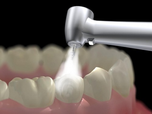 Root Canals Lancaster California