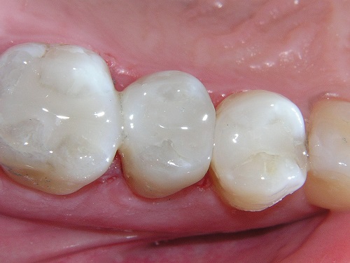White Teeth filling Lancaster